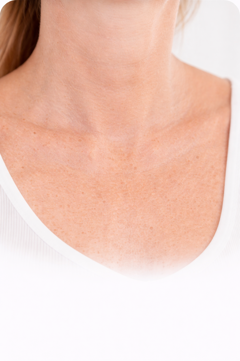 Seringue de Hyafilia V Plus – acide hyaluronique réticulé avec lidocaïne pour correction des volumes (pommettes, menton)